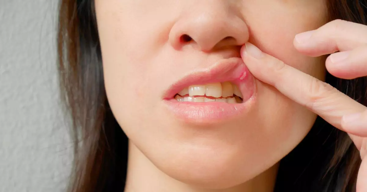 home remedies for canker sores