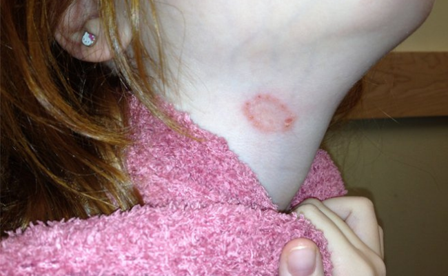 Signs of Ringworm- home remedies for ringworm