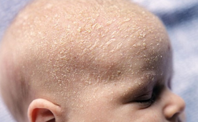 Home Remedies For Cradle Cap Get Rid Of It Quickly
